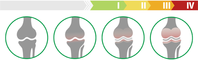 Clinical stages of osteoarthritis of the knee (degree of osteoarthritis of the knee)