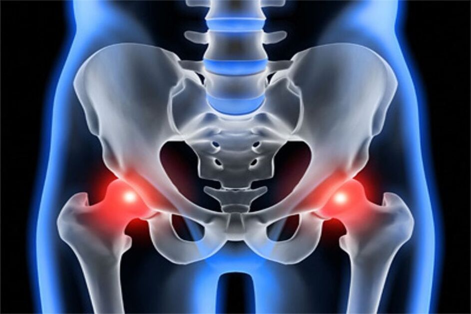 Osteoarthritis of the thigh joints (coxarthrosis)