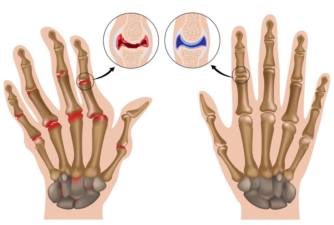 Joints of healthy hands and those affected by polyarthritis
