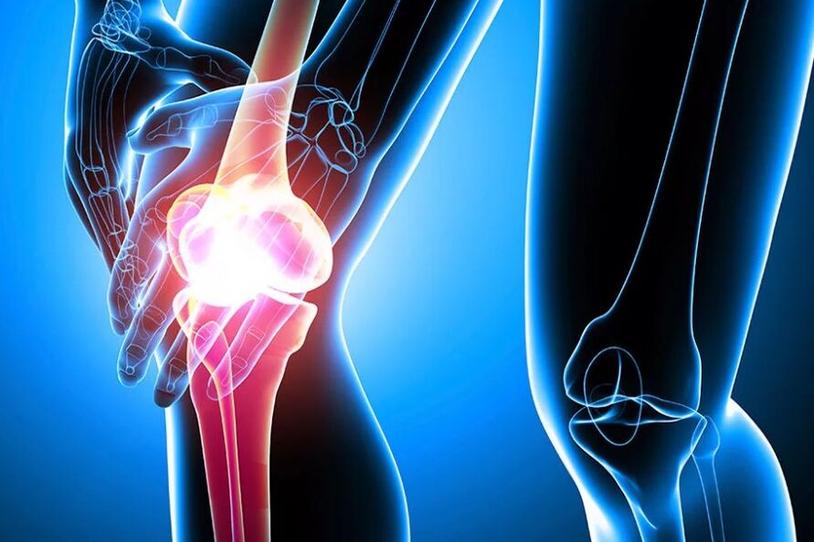 Arthritis