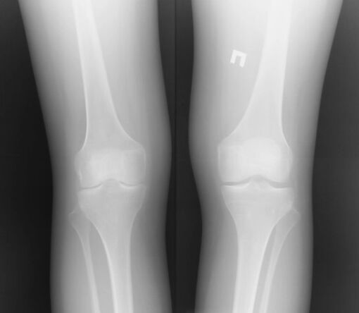 Knee node radiography