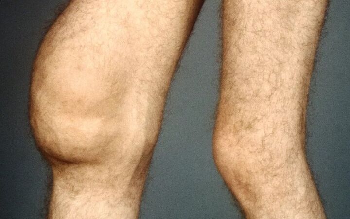 Post -traumatic arthritis of the knee joint