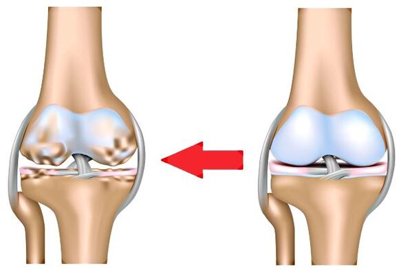 Healthy and arthritis union