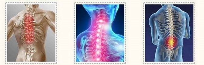 Osteochondrosis spinal lesions